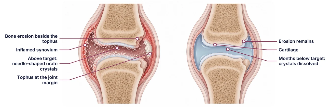 A joint with urate crystals and a tophus beside the same joint after urate has been lowered